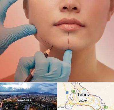 دکتر زیبایی خانم در تبریز