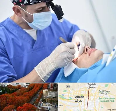 جراح سرطان چشم در ولیعصر 
