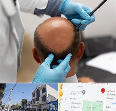 آموزش کاشت مو در افسریه 
