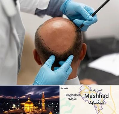 آموزش کاشت مو در مشهد