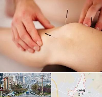 دکتر طب سوزنی برای لاغری در گوهردشت کرج 