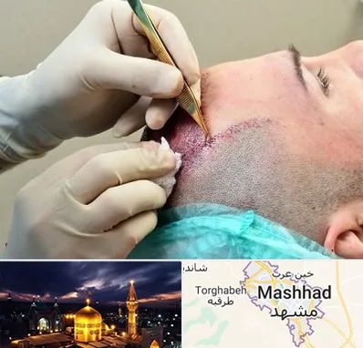 کلینیک کاشت مو در مشهد