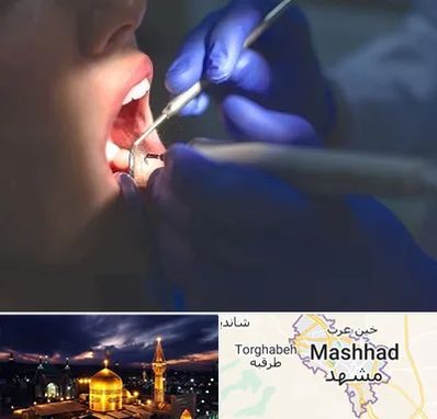عصب کشی در مشهد