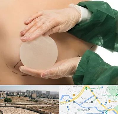 جراحی پروتز سینه در کوی وحدت شیراز