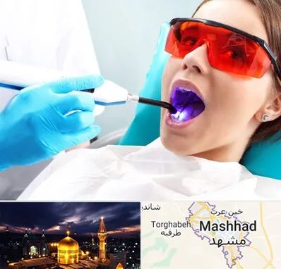 جراحی لثه با لیزر در مشهد