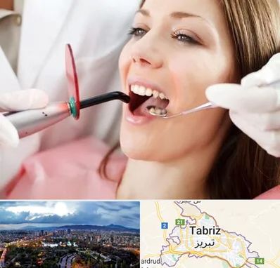 متخصص درمان ریشه دندان در تبریز