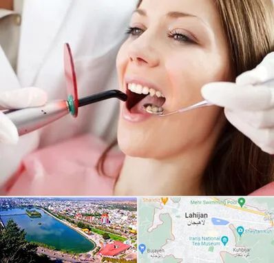 متخصص درمان ریشه دندان در لاهیجان