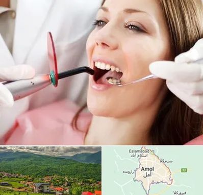 متخصص درمان ریشه دندان در آمل