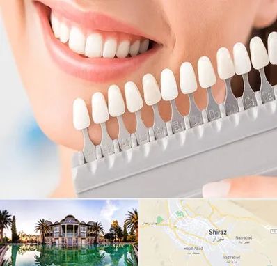 متخصص لمینت دندان در شیراز