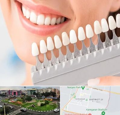 متخصص لمینت دندان در تهرانسر 
