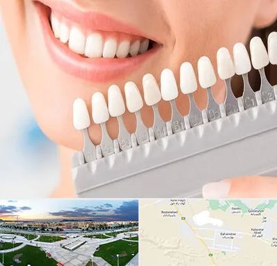متخصص لمینت دندان در بهارستان اصفهان