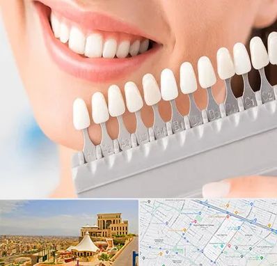 متخصص لمینت دندان در هاشمیه مشهد