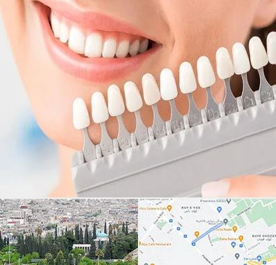 متخصص لمینت دندان در محلاتی شیراز