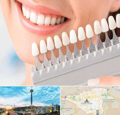 متخصص لمینت دندان در تهران