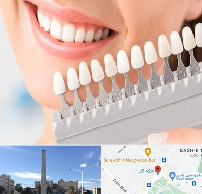 متخصص لمینت دندان در فلکه گاز شیراز