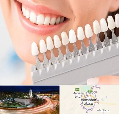 متخصص لمینت دندان در همدان