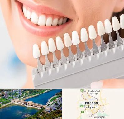 متخصص لمینت دندان در اصفهان