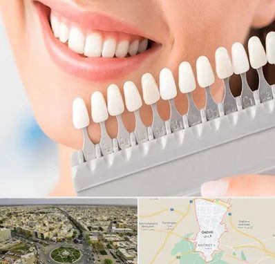 متخصص لمینت دندان در قزوین