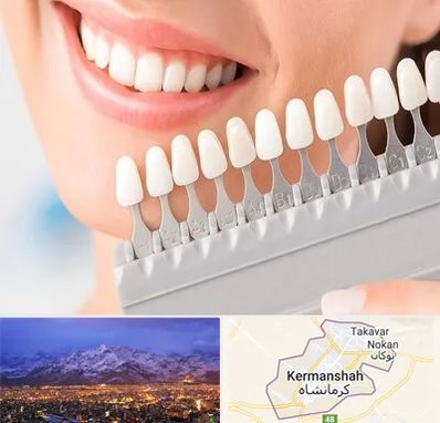متخصص لمینت دندان در کرمانشاه