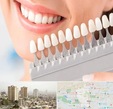 متخصص لمینت دندان در منطقه 5 تهران
