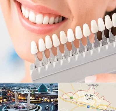 متخصص لمینت دندان در زنجان