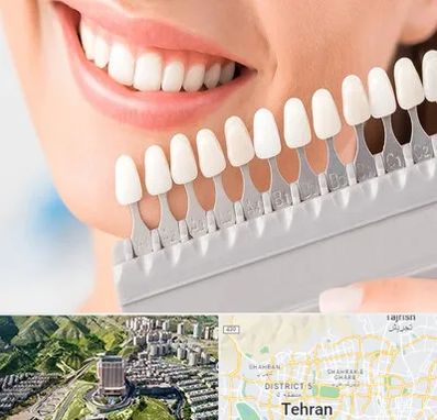 متخصص لمینت دندان در شمال تهران 