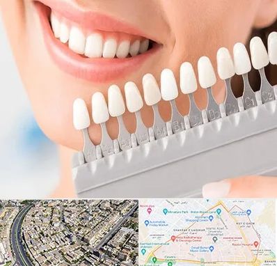 متخصص لمینت دندان در شهرک غرب مشهد