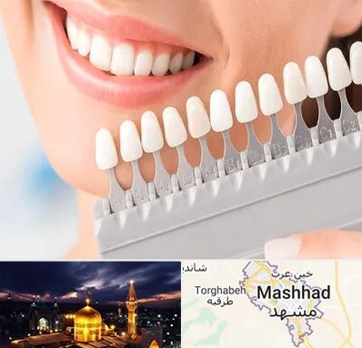 متخصص لمینت دندان در مشهد