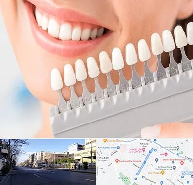 متخصص لمینت دندان در خیابان ملاصدرا شیراز