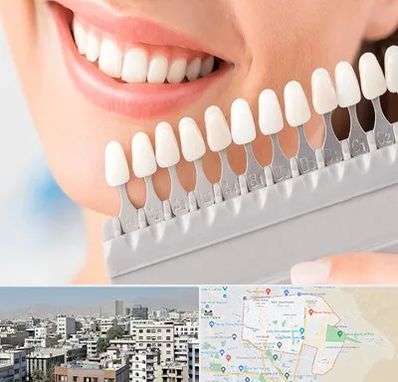 متخصص لمینت دندان در منطقه 14 تهران