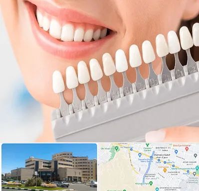 متخصص لمینت دندان در صیاد شیرازی مشهد