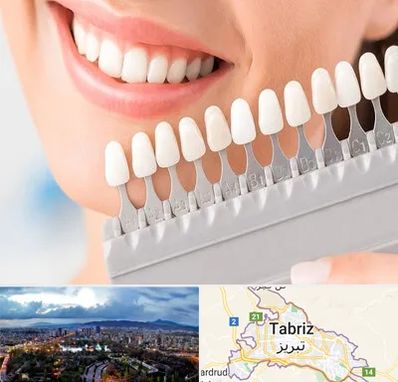 متخصص لمینت دندان در تبریز