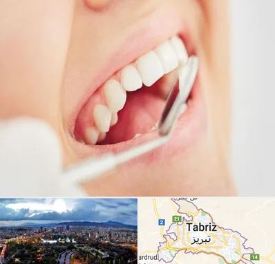 اصلاح طرح لبخند در تبریز