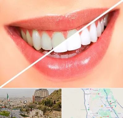 بلیچینگ دندان در فرهنگ شهر شیراز