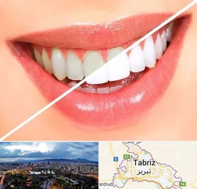 بلیچینگ دندان در تبریز
