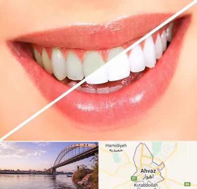 بلیچینگ دندان در اهواز
