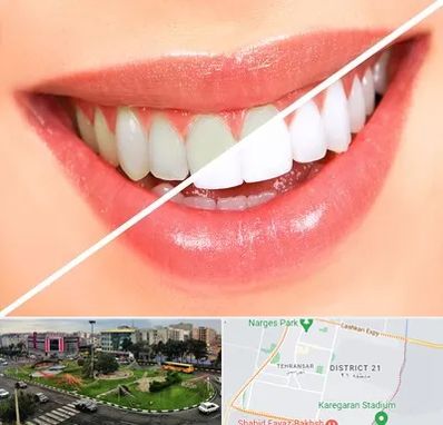 بلیچینگ دندان در تهرانسر 