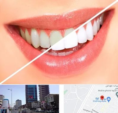 بلیچینگ دندان در چهارراه طالقانی کرج
