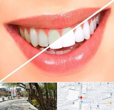 بلیچینگ دندان در خیابان توحید اصفهان