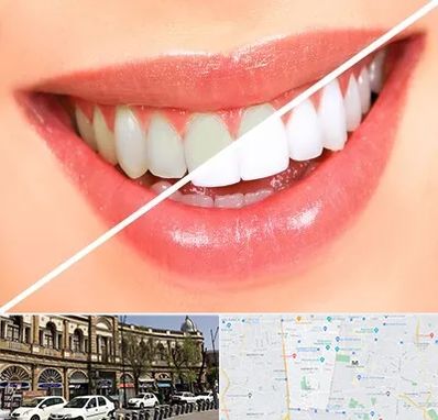 بلیچینگ دندان در منطقه 11 تهران