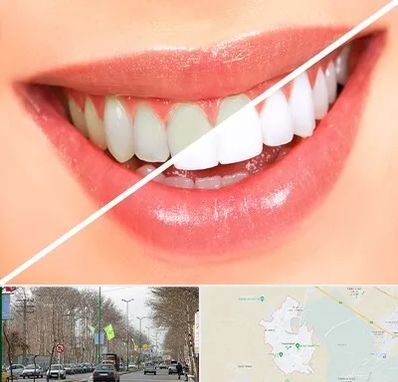 بلیچینگ دندان در نظرآباد کرج