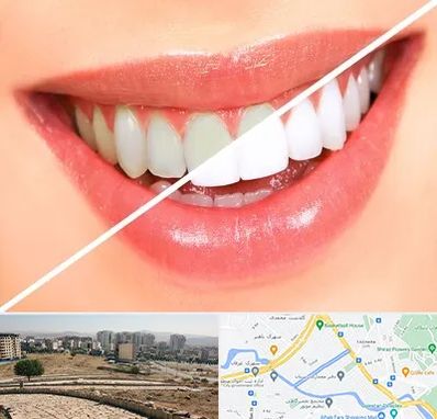 بلیچینگ دندان در کوی وحدت شیراز