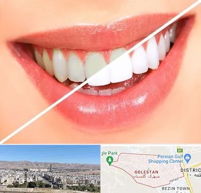 بلیچینگ دندان در شهرک گلستان شیراز