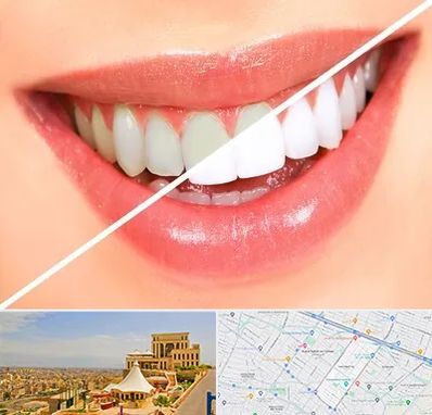 بلیچینگ دندان در هاشمیه مشهد