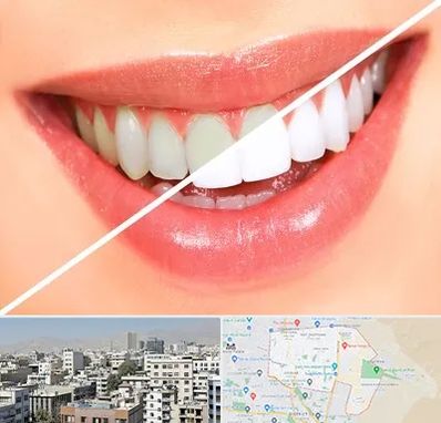 بلیچینگ دندان در منطقه 14 تهران