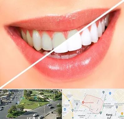 بلیچینگ دندان در شاهین ویلا کرج