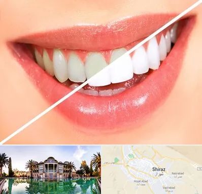 بلیچینگ دندان در شیراز