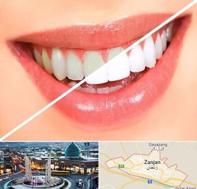 بلیچینگ دندان در زنجان
