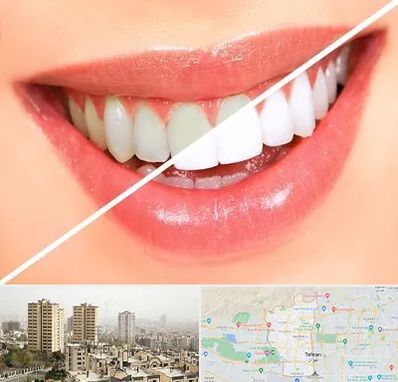 بلیچینگ دندان در منطقه 5 تهران