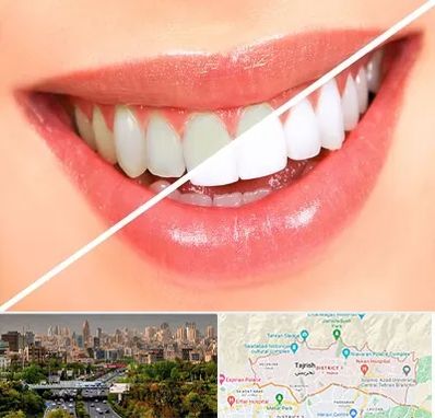 بلیچینگ دندان در منطقه 1 تهران